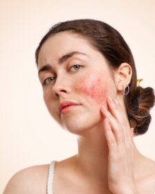 Calm the Curse of the Celts: Yon-Ka’s targeted skincare solutions for rosacea-prone skin-BEAUTIFULJOBS