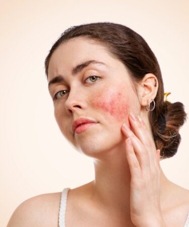Calm the Curse of the Celts: Yon-Ka’s targeted skincare solutions for rosacea-prone skin-BEAUTIFULJOBS