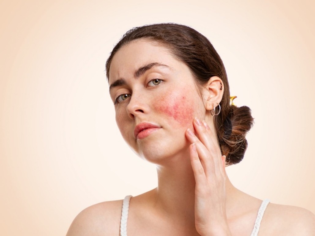 Calm the Curse of the Celts: Yon-Ka’s targeted skincare solutions for rosacea-prone skin-BEAUTIFULJOBS